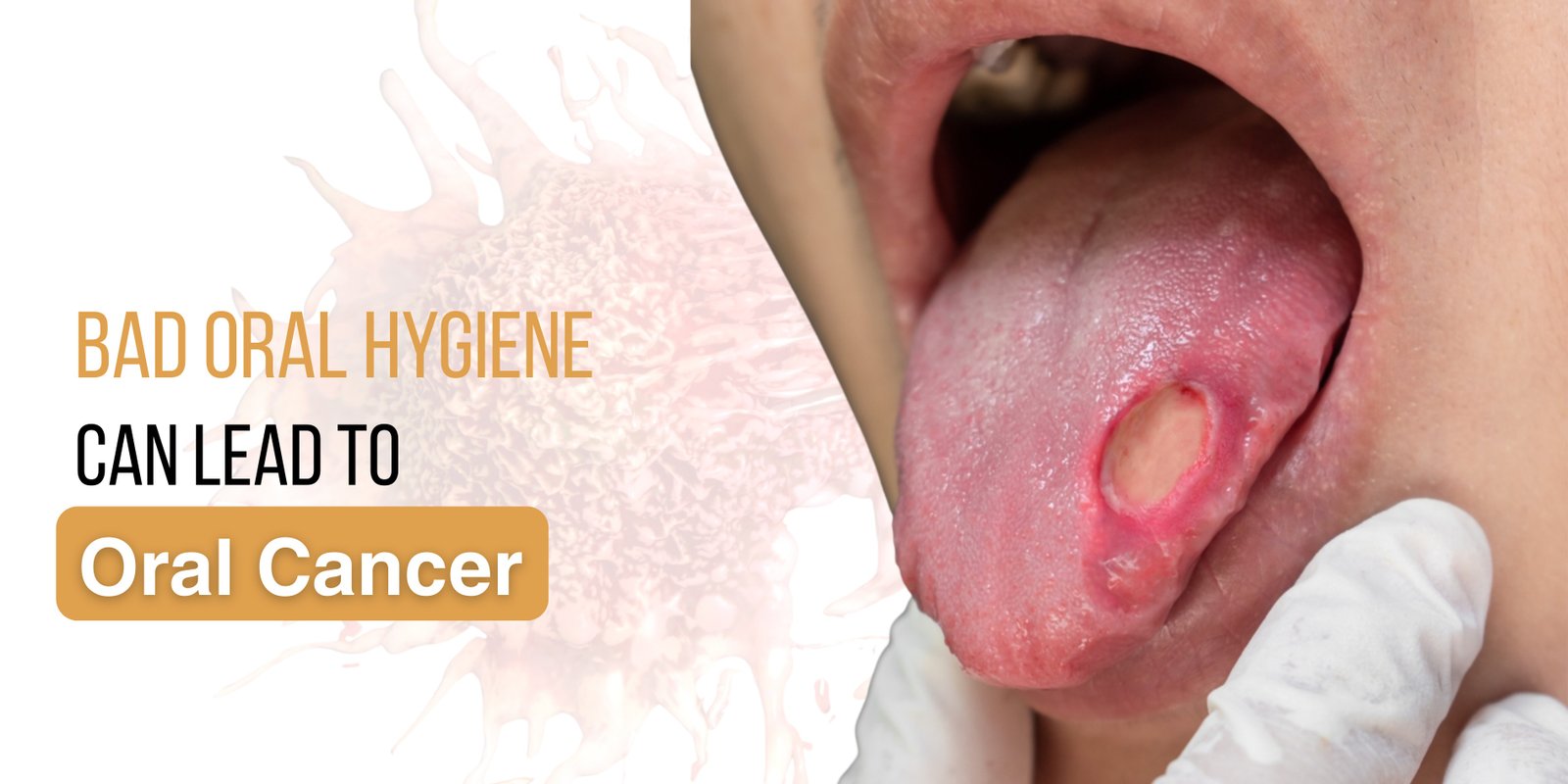 Best-dentist-in-ghaziabad-explains-how-poor-oral-hygiene-can-lead-to-oral-cancer-and-why-early-denta